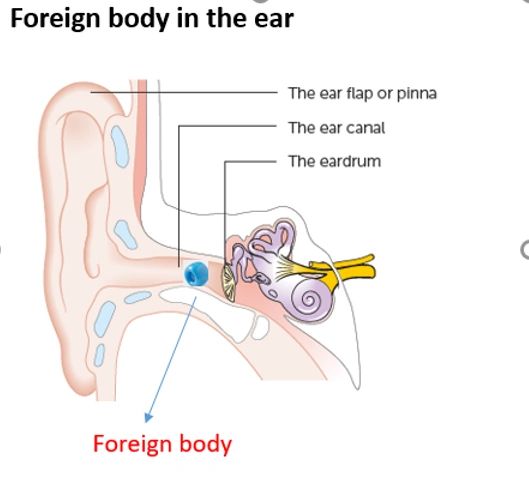 Ear wax removal Fleet