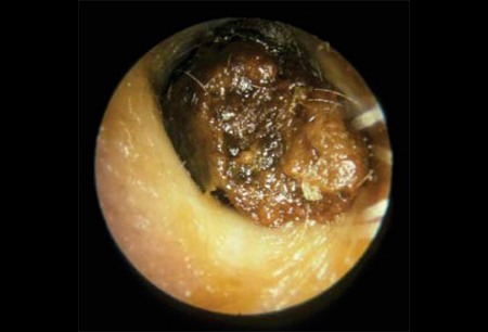 EAR WAX REMOVAL 1