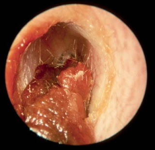 EAR WAX 1