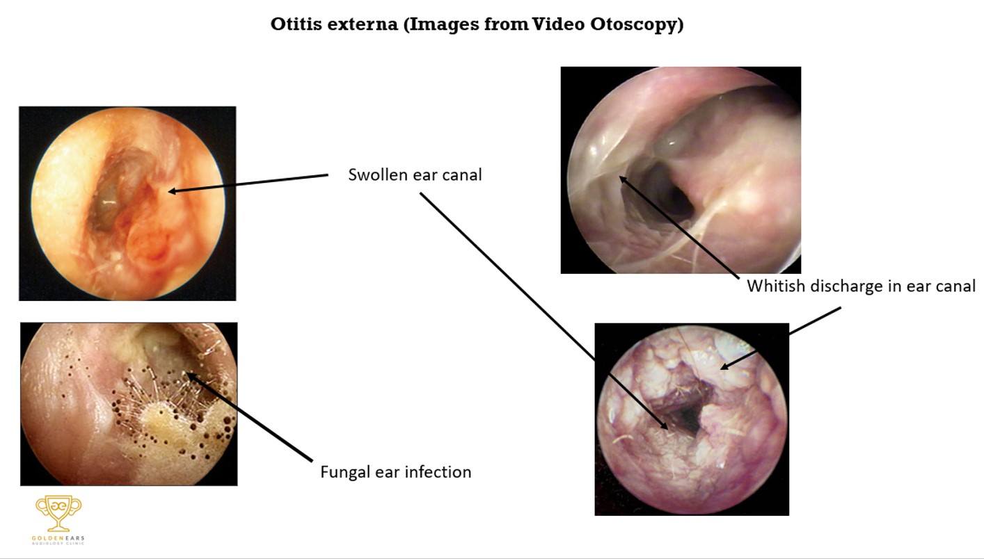 Otitis Externa