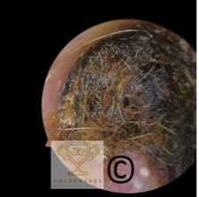 Ear wax removal (Adults) 2